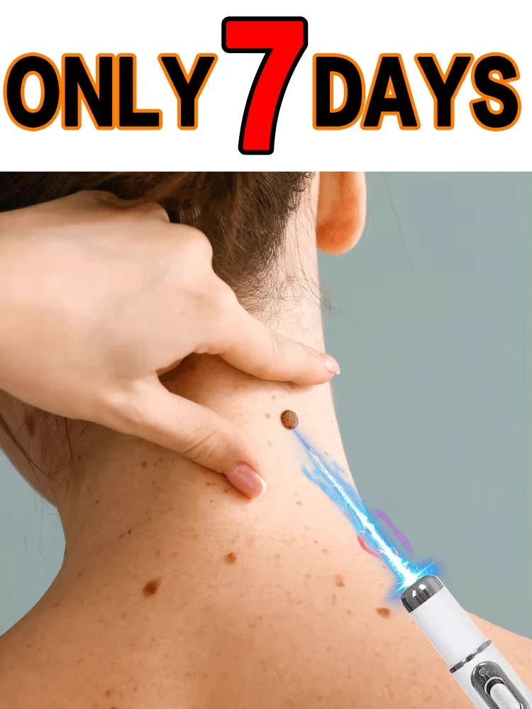 Hot selling blue light pen to solve body warts, wart care tools