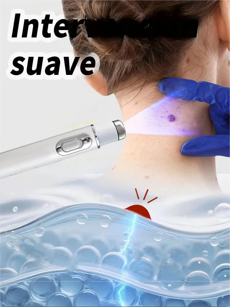 Hot selling blue light pen to solve body warts, wart care tools
